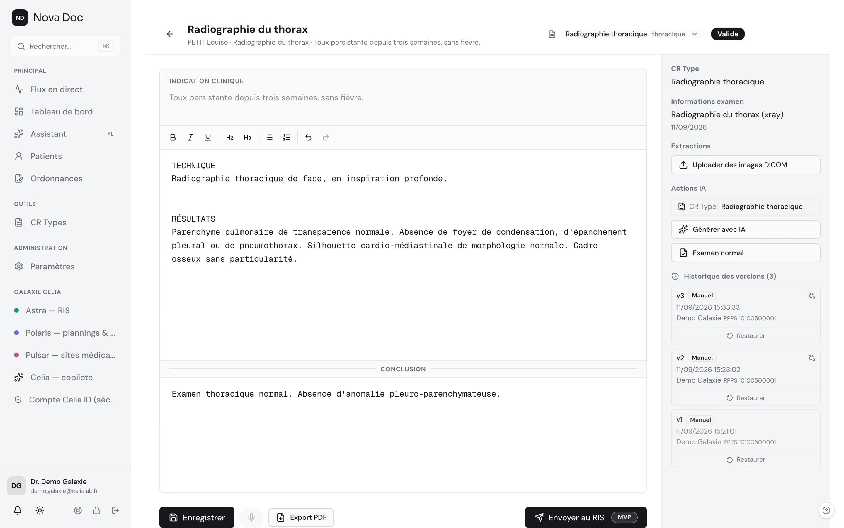 Compte rendu de radiographie du thorax au statut Validé ; à droite, l'historique des versions v1 à v3, chacune datée et rattachée au RPPS du radiologue.